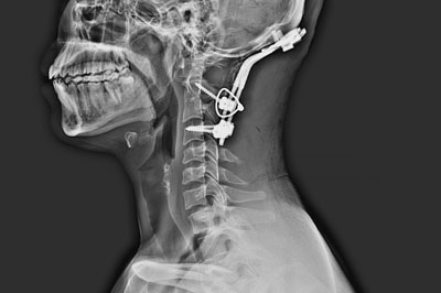 cervical-spine-surgery