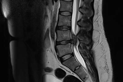 disc-prolapse