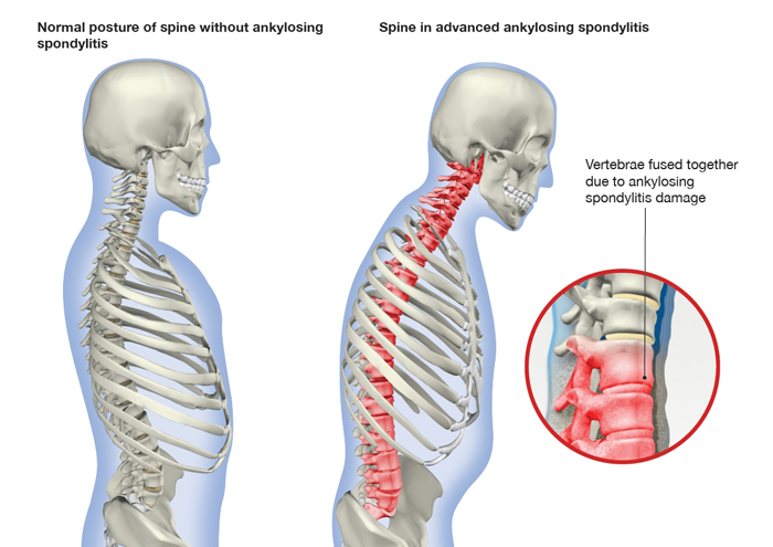 Ankylosing-Spondylitis Ankylosing-Spondylitis