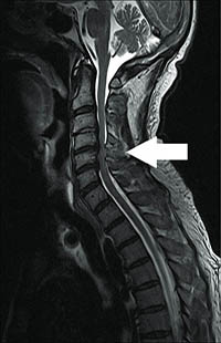 compressive-myelopathy compressive-myelopathy