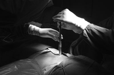 minimally-invasive-spine-surgery