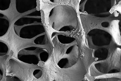 osteoporosis