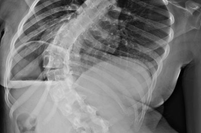 spinal-deformity