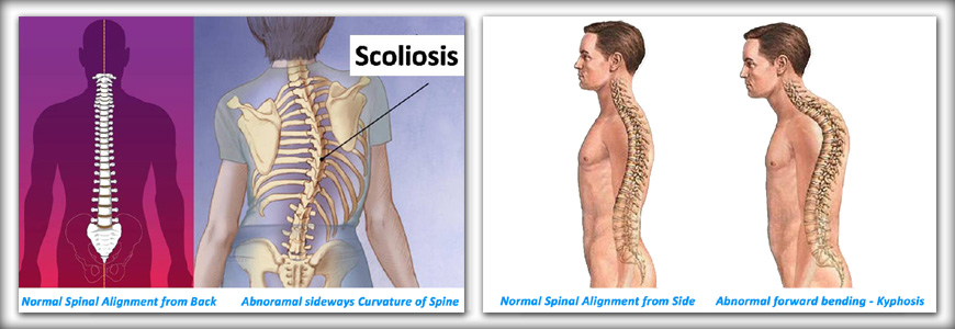 spinal-deformity-intro spinal-deformity-intro