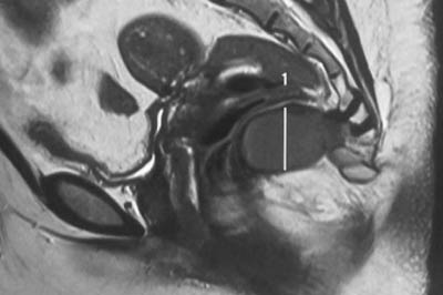 spinal-tumours