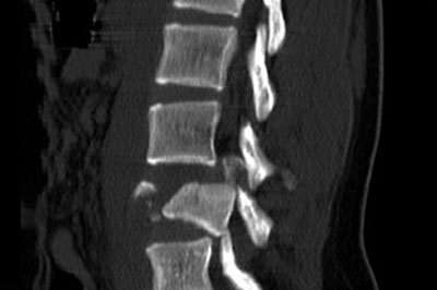 spine-fracture