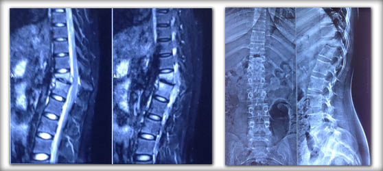 spine-infection-intro spine-infection-intro