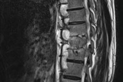 spondylodiscitis