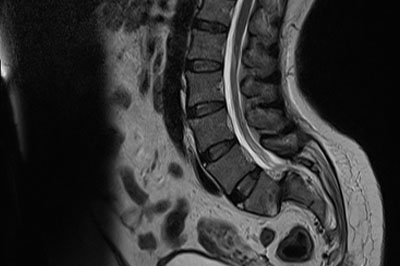 spondylolishthesis