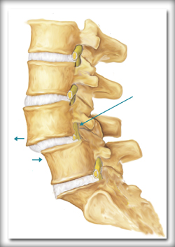 spondylolishthesis-intro spondylolishthesis-intro